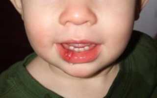 Ребенок разбил губу изнутри опухла