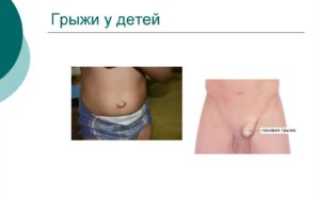 Паховая Грыжа У Детей Мальчиков Фото Лечение