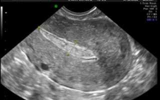 Остатки плодного яйца после медикаментозного прерывания