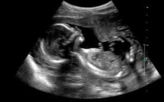 Покалывания 18 неделе беременности