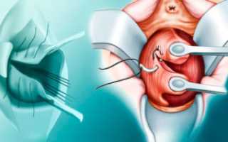 Швы после родов на шейке матки фото