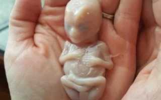 Выкидыш 8 9 недели беременности