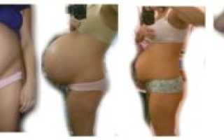 Живот фото после родов двойни